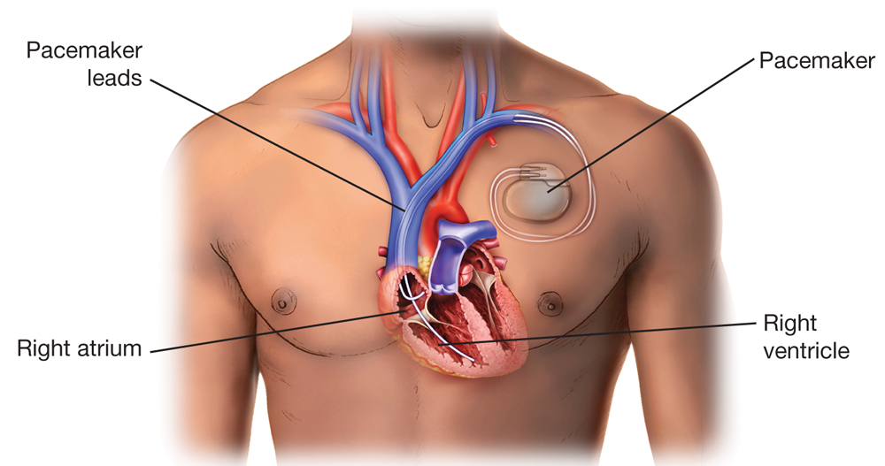 Pacemaker Envelope Tizra Reader